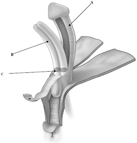 elongated clitorus|Treatment of the Enlarged Clitoris .